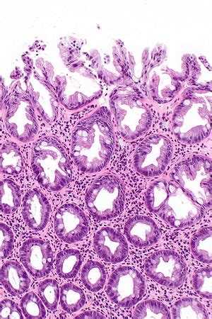 Hyperplastic polyp - Libre Pathology