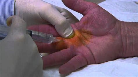 Trigger Finger Surgery Cost With Insurance - Life Insurance Quotes