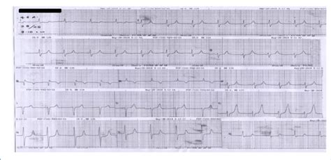 b): The subsequent ECG showing tall tented T waves with absent P waves,... | Download Scientific ...