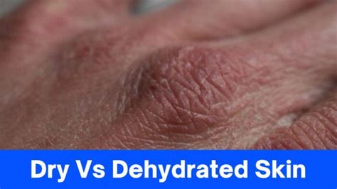 9+ Differences Between Dry Vs Dehydrated Skin, Recognize The ...