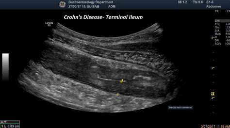 Terminal Ileitis [1 image] – EFSUMB