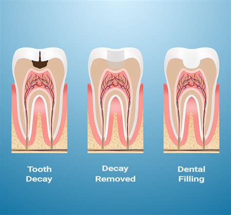 Do I Need a Dental Crown or A Tooth Filling? - Willow Pass Dental Care