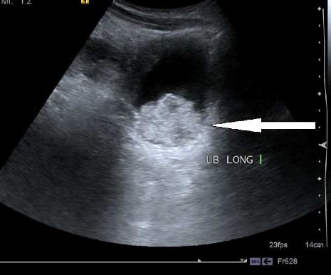 Mycetoma Ultrasound