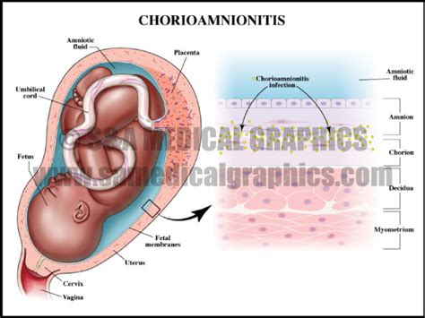 Birth Injury - S&A Medical Graphics