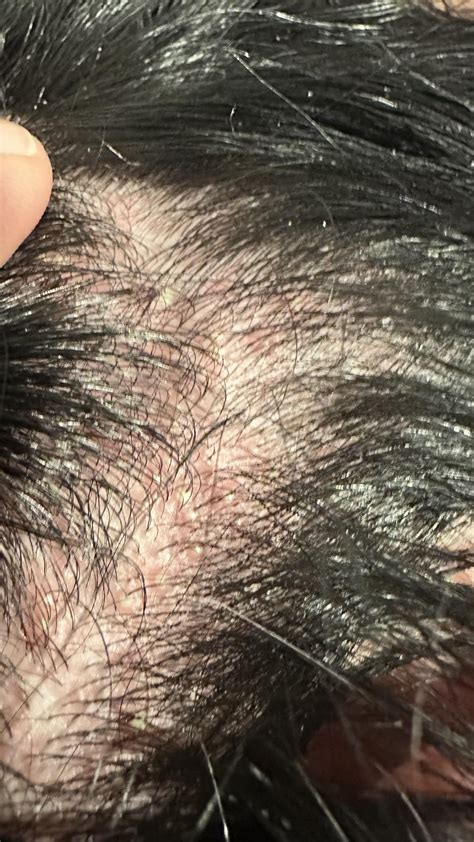 Painful bumps over most of my scalp, what is this? Popped up 2 days ago and felt tender to touch ...