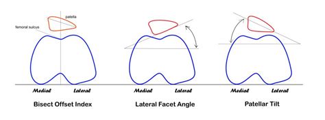 Does Patellar Tracking Disorder Cause Knee Pain? - Massage & Fitness Magazine