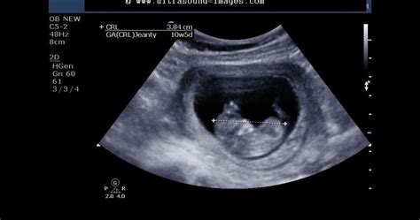 Ultrasound imaging: Fetal 3D-ultrasound images at 10 weeks