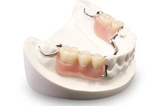 Removable Cast Metal Elite Partial Denture | DDS Lab