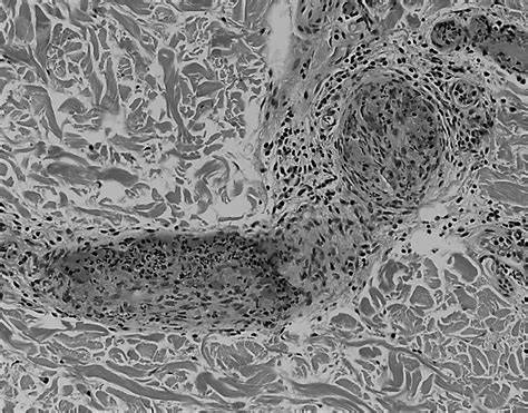 Levamisole vs. Autoimmune Leukocytoclastic Vasculitis | Bella | Journal ...