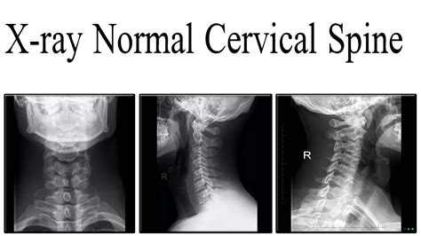 X-ray Normal cervical spine anatomy - YouTube