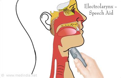 Laryngectomy - Procedure, Risks and Post Laryngectomy Therapy