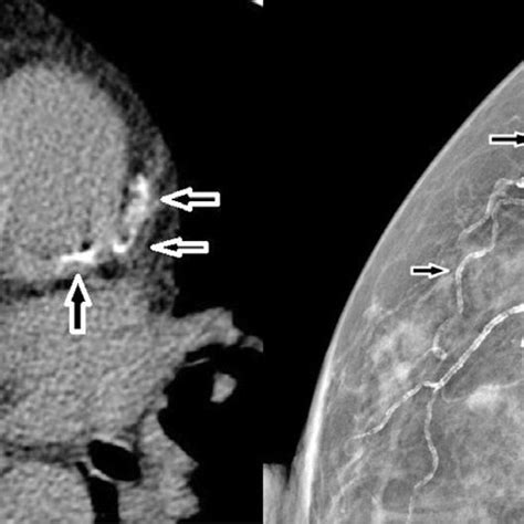 Mild calcification in the left anterior descending coronary artery of a ...