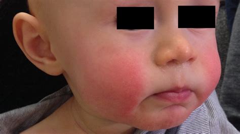 Baby Rash On Face From Teething at Antionette Salzman blog