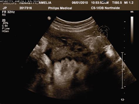 Henretty Happenings: Ultrasound pictures - 31 weeks