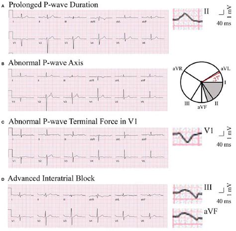 Knowledge Of ECG ?Figure: Common ECG Abnormalities? ?Guys, 56% OFF