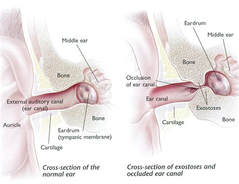 Exostoses Surfer's Ear - Dr Bridget Clancy | ENT Surgeon