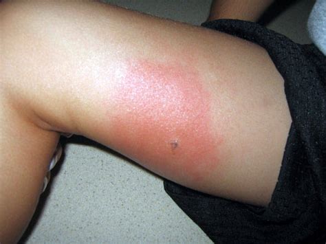 Hindustanlink.com: Health Care Blog » Symptoms Of Mosquito and Insect Bite