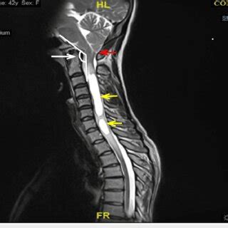 MRI of the patient showing cerebellar tonsillar herniation and ...