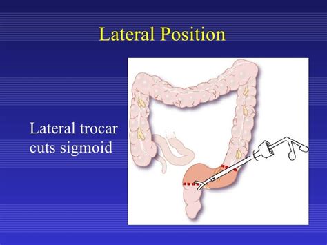 Laparoscopic Sigmoid Colon Resection for Diverticular Disease