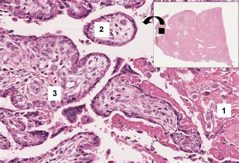 Histology of the placenta showing the myometrium (1) with invasions of... | Download Scientific ...