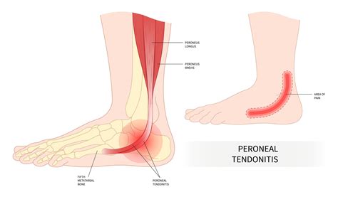 Peroneus Brevis Tendon Injury - ProHealth Prolotherapy Clinic