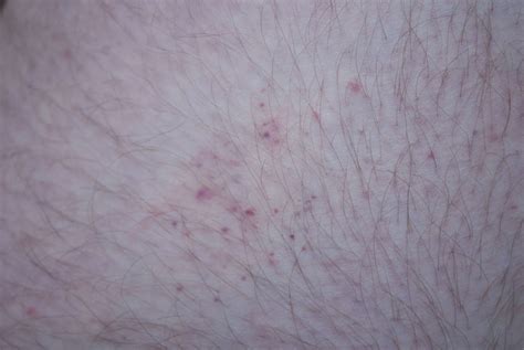 File:Bedbug bites on human thigh 2.jpg