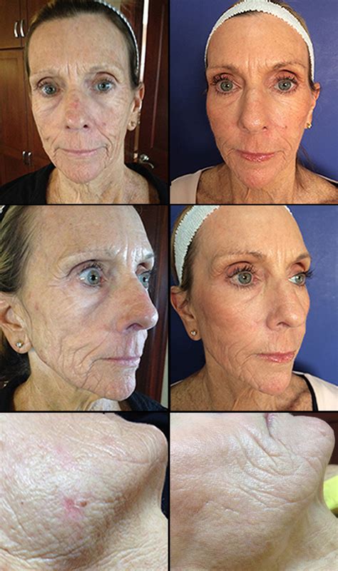 CO2 Laser Skin Resurfacing | Dr Monica Scheel Dermatology, Kailua-Kona, HI