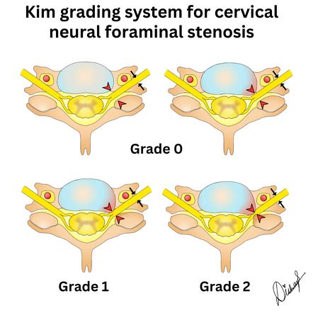 Neural Foraminal Stenosis