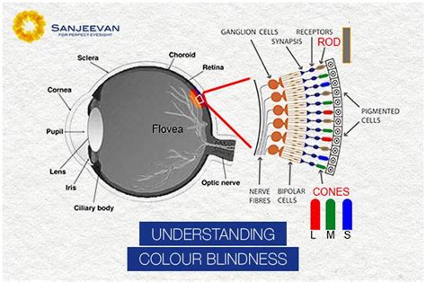 Colour Blindness Treatment in India | Sanjeevan