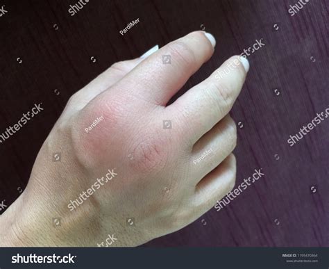 Infection After Bee Sting Swollen Hand Stock Photo (Edit Now) 1195470364