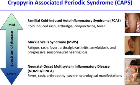 CAPS — pathogenesis, presentation and treatment of an autoinflammatory disease | SpringerLink