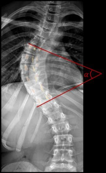 The Cobb angle is the α angle evaluated on this radiography of the... | Download Scientific Diagram