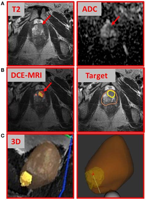 Multiparametric-MRI findings and directed prostate biopsy of the index ...