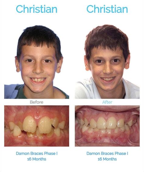 People Before And After Braces