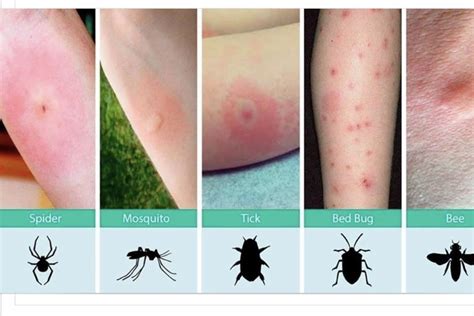 Pin by Mary smith on Medicine | Bug bites, Insect bites, Spider bites