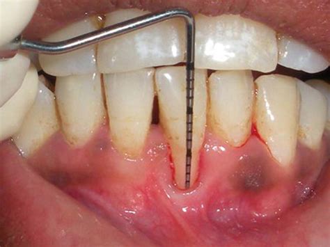 Cornerstone Dental Care : Periodontal Probing