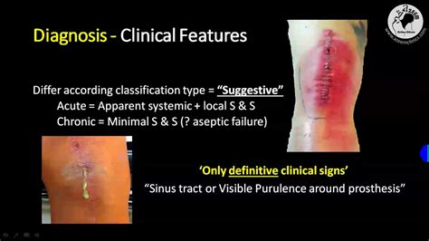 REVISION TOTAL KNEE ARTHROPLASTY and Periprosthetic Infection PJI TKA - YouTube