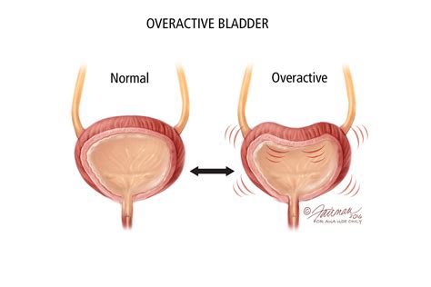 Overactive Bladder (OAB): Symptoms, Diagnosis & Treatment - Urology ...