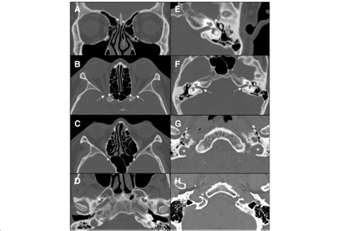 CT aspect of the most important foramina of the skull base. a ...