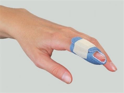 Finger Fracture - Activate Physiotherapy