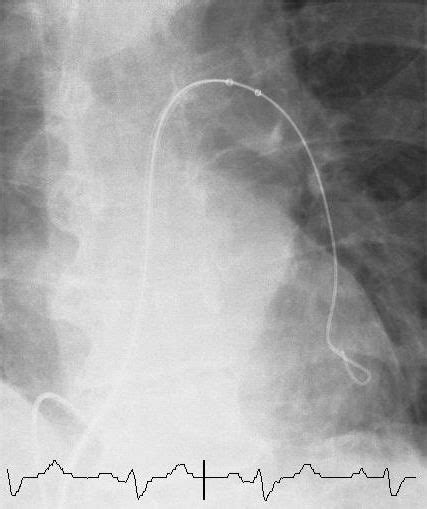 Selective pulmonary angiogram. Selective pulmonary angiogram showing... | Download Scientific ...