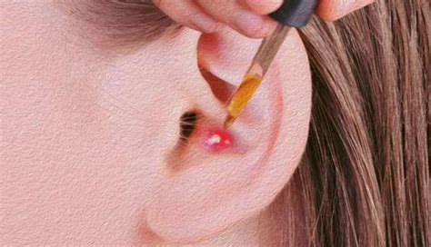 5 Home Remedies To Treat Pimple in Ear - lifeberrys.com