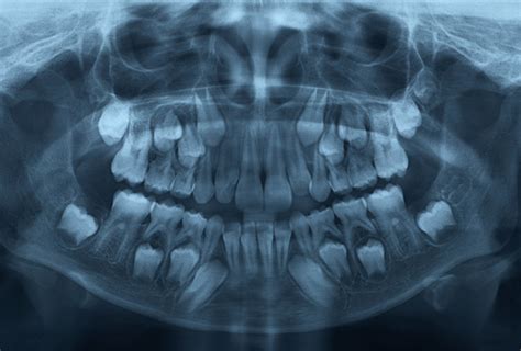 Pediatric Dental X-rays (Radiography) - Lonestar Kid’s Dentistry