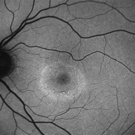 Moran CORE | Bilateral Bull’s Eye Maculopathy