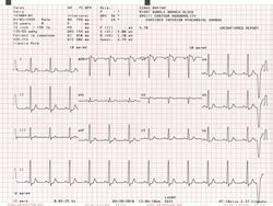 ECG Interpretation: How to Read an Electrocardiogram - USA Medical and ...