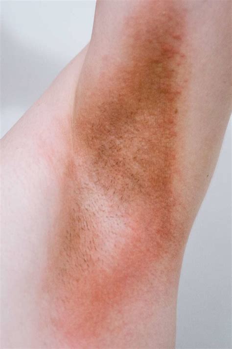 Psoriasis and Candida: Are they linked?