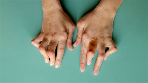 What Are Rheumatoid Nodules?