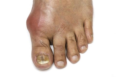 Gout: Symptoms, causes, and treatment