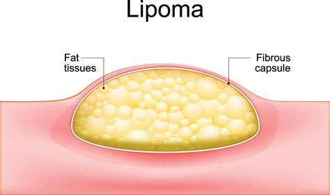 Lipoma Symptoms And Causes Fatty Tumor Fatty Lump Und - vrogue.co