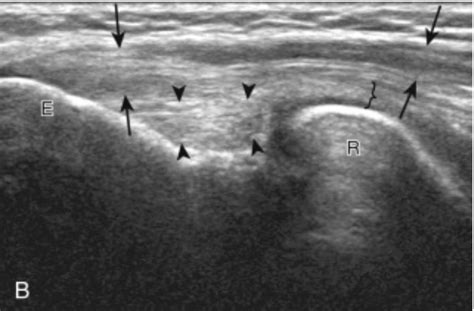 Quick Guide to Diagnostic Ultrasound of the Elbow - Sports Medicine Review